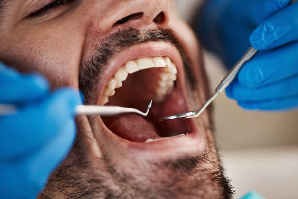 Best Emergency Dental Extractions in Trexlertown, PA